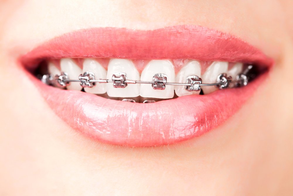 Brackets de autoligado