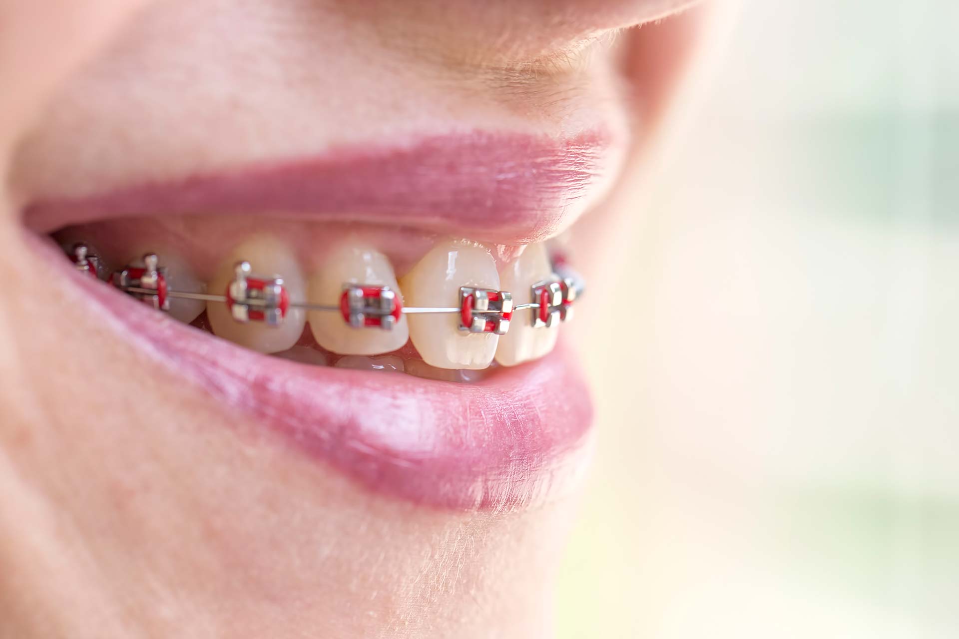 Brackets metálicos